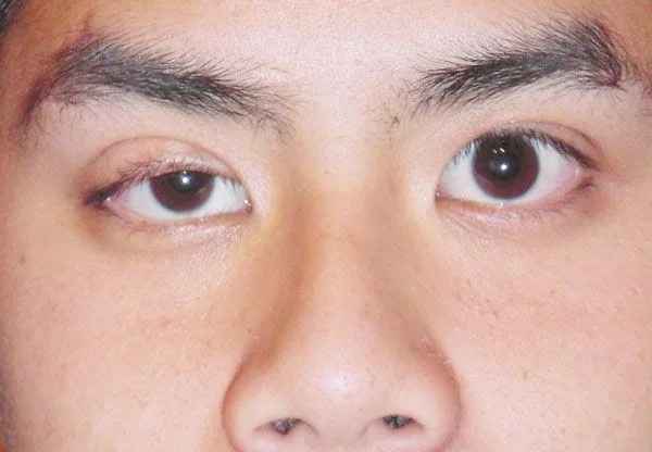 Ptosis Surgery in Amritsar