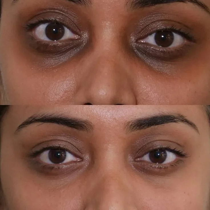 Ptosis Surgery in Amritsar