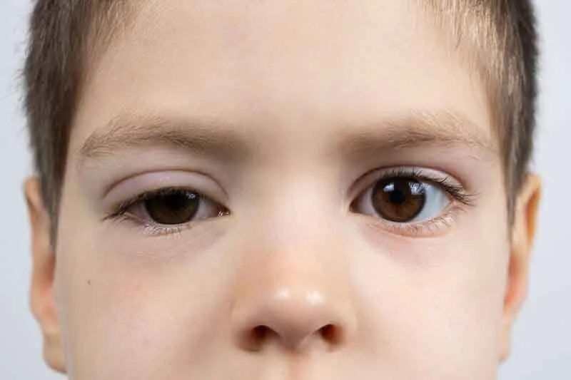 Ptosis Surgery in Amritsar