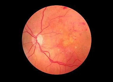 diabetic eye care in Amritsar