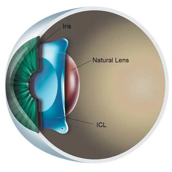 ICL Surgery in Amritsar