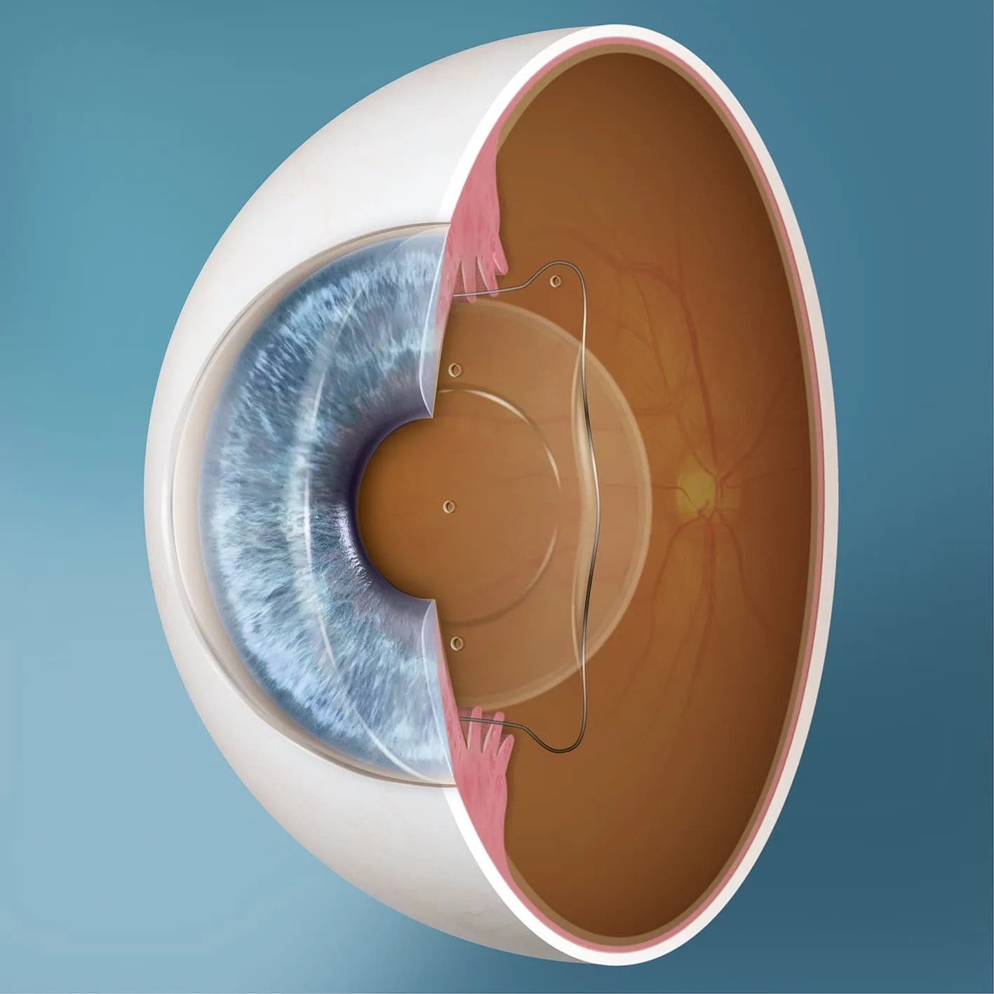 ICL Surgery in Amritsar