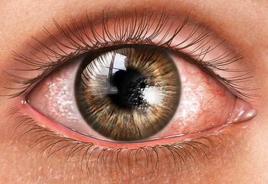 imgi_1_dry-eye-syndrome-facts