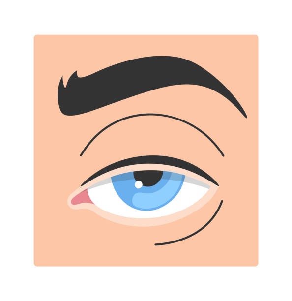 imgi_1_ptosis-human-eye-disease
